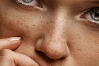 Pigmentfolt- halványítás otthon