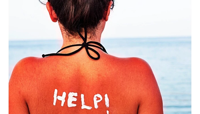 Napégés kezelése: Mit tegyél, és mit ne – szakértői tippek napozás, napégés után